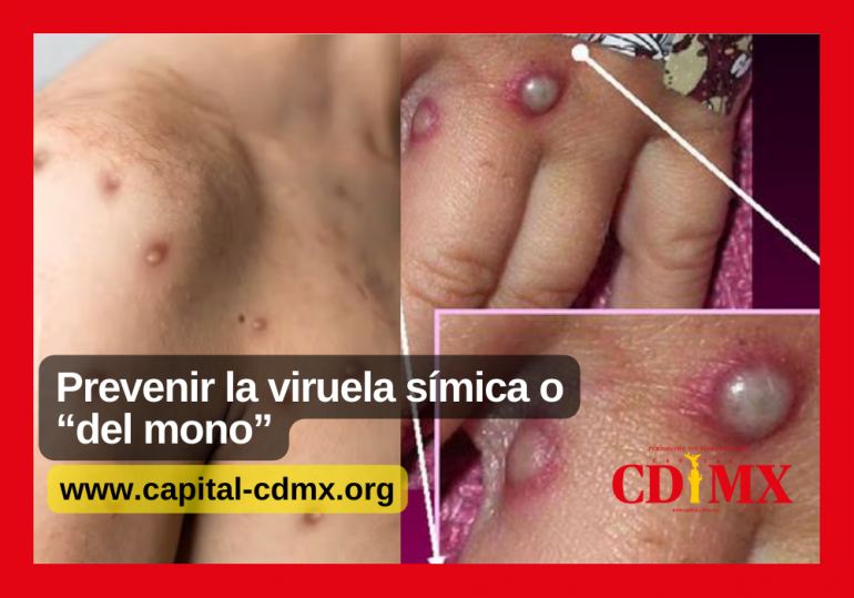 Prevenir la viruela símica o “del mono”