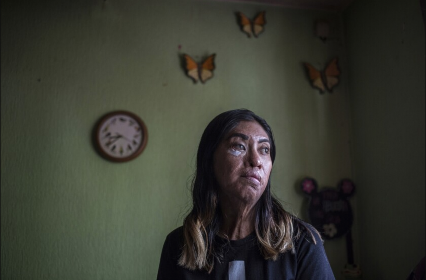 Esmeralda Millán, sobreviviente de un ataque con ácido por parte de su ex pareja
