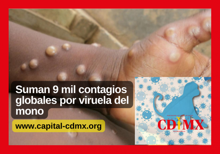 Suman 9 mil contagios globales por viruela del mono