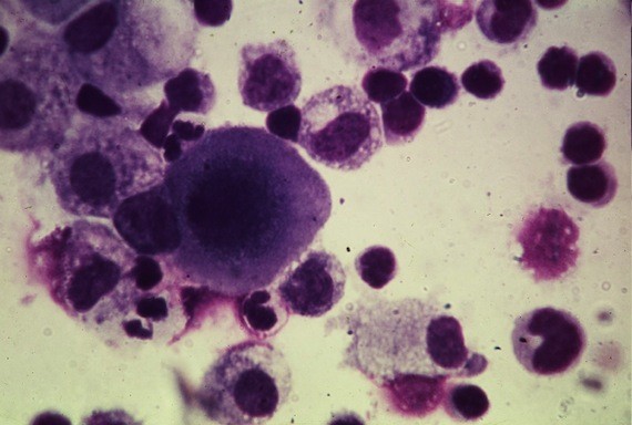 Buscan científicos de la UNAM detener la metástasis del cáncer